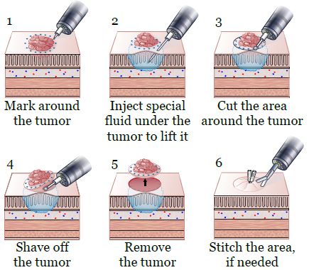 Heart Treatment in Gurgaon